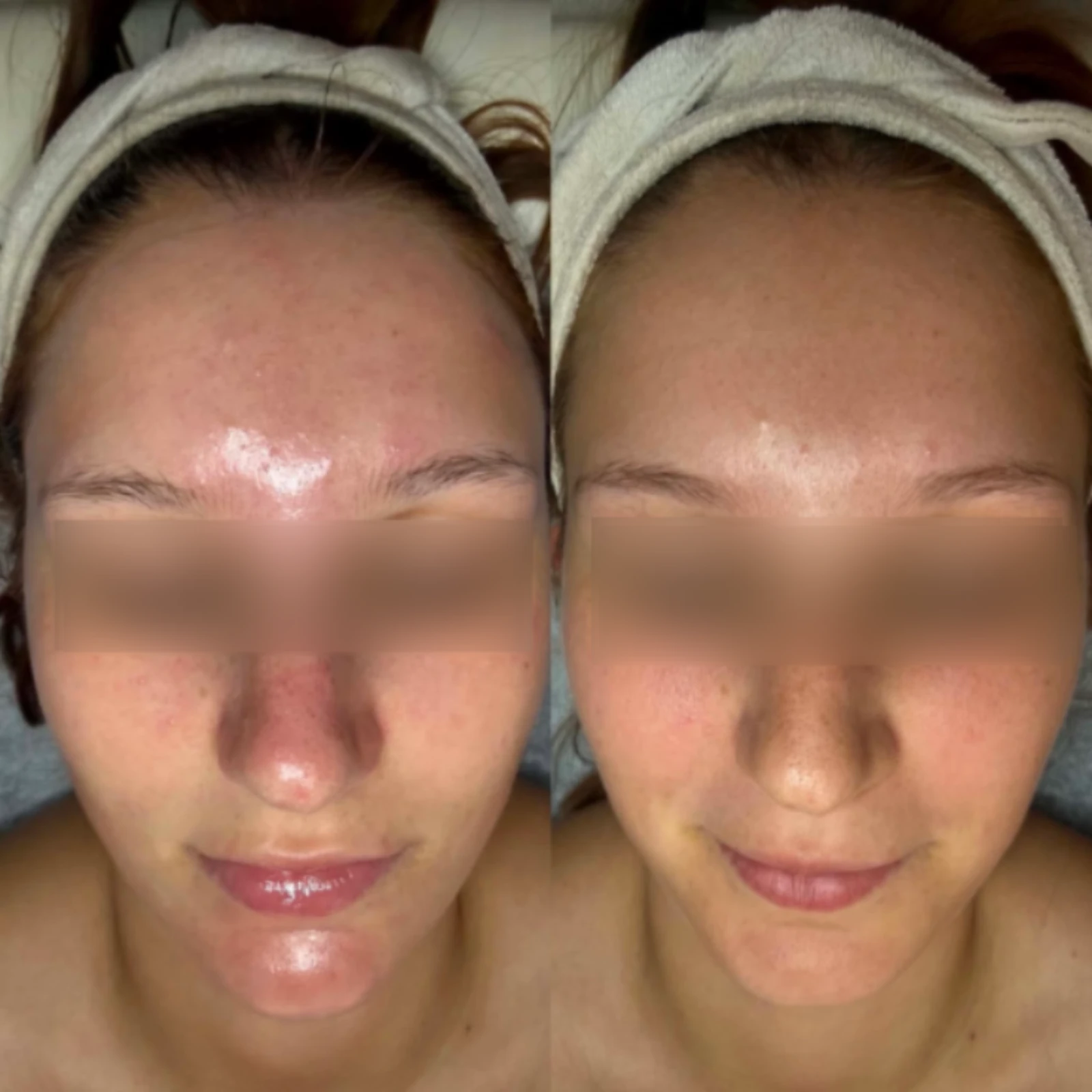 Dermaplaning