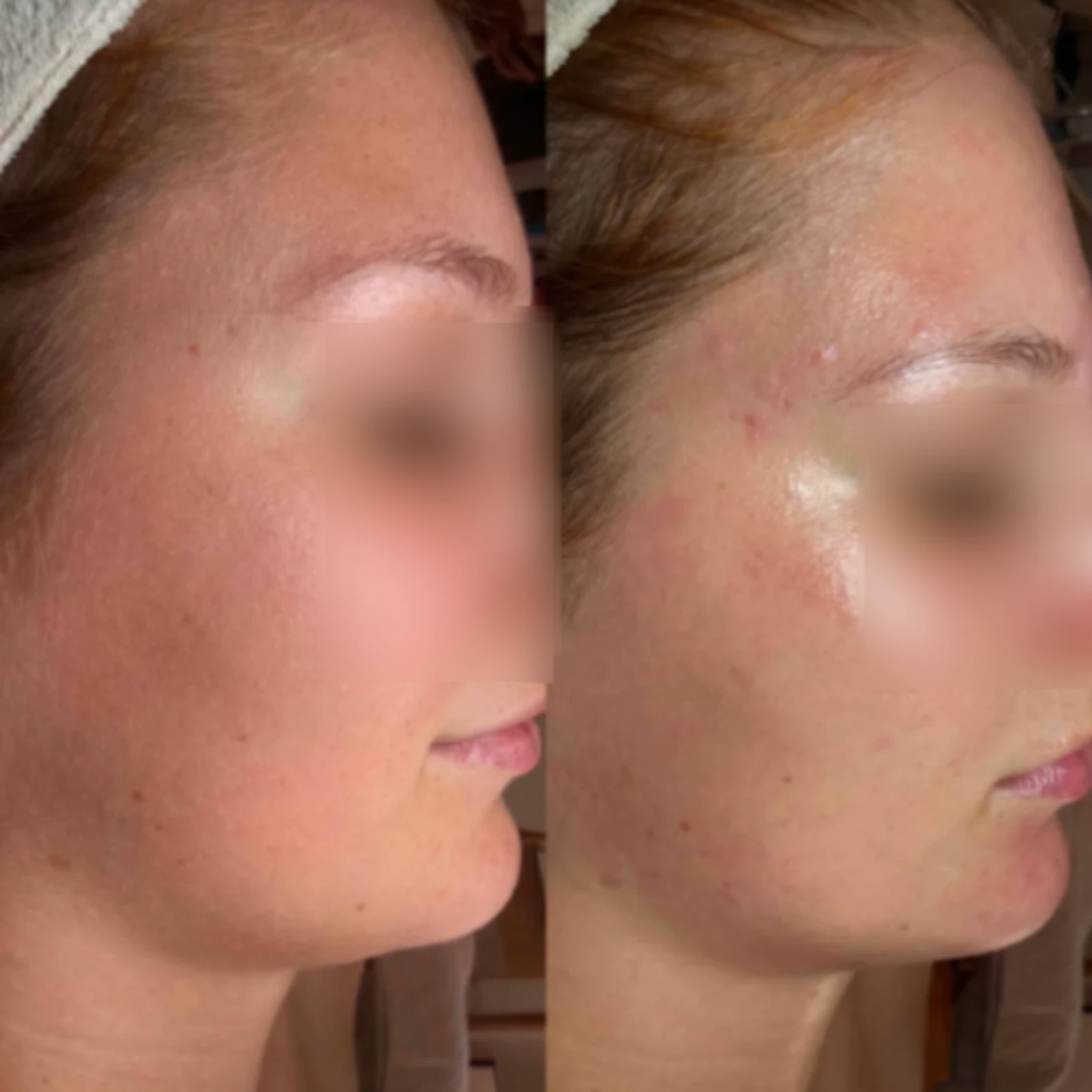 Dermaplaning