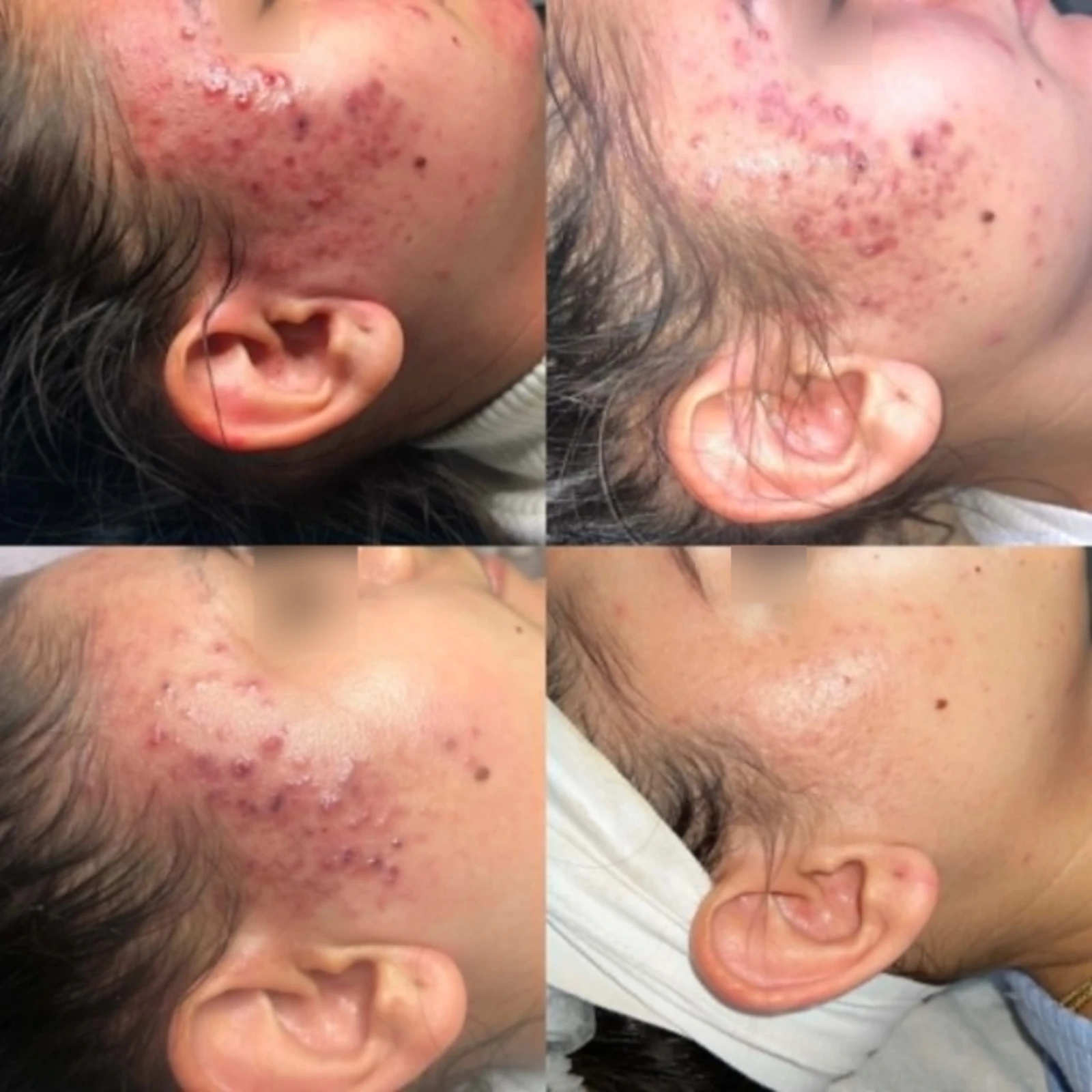 Hollywood Carbon Peeling & Akne Program