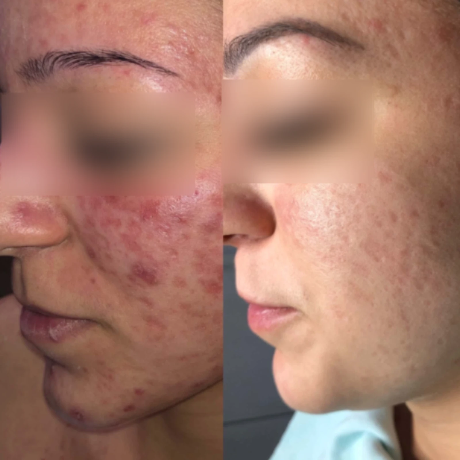 Hollywood Carbon Peeling & Akne Program