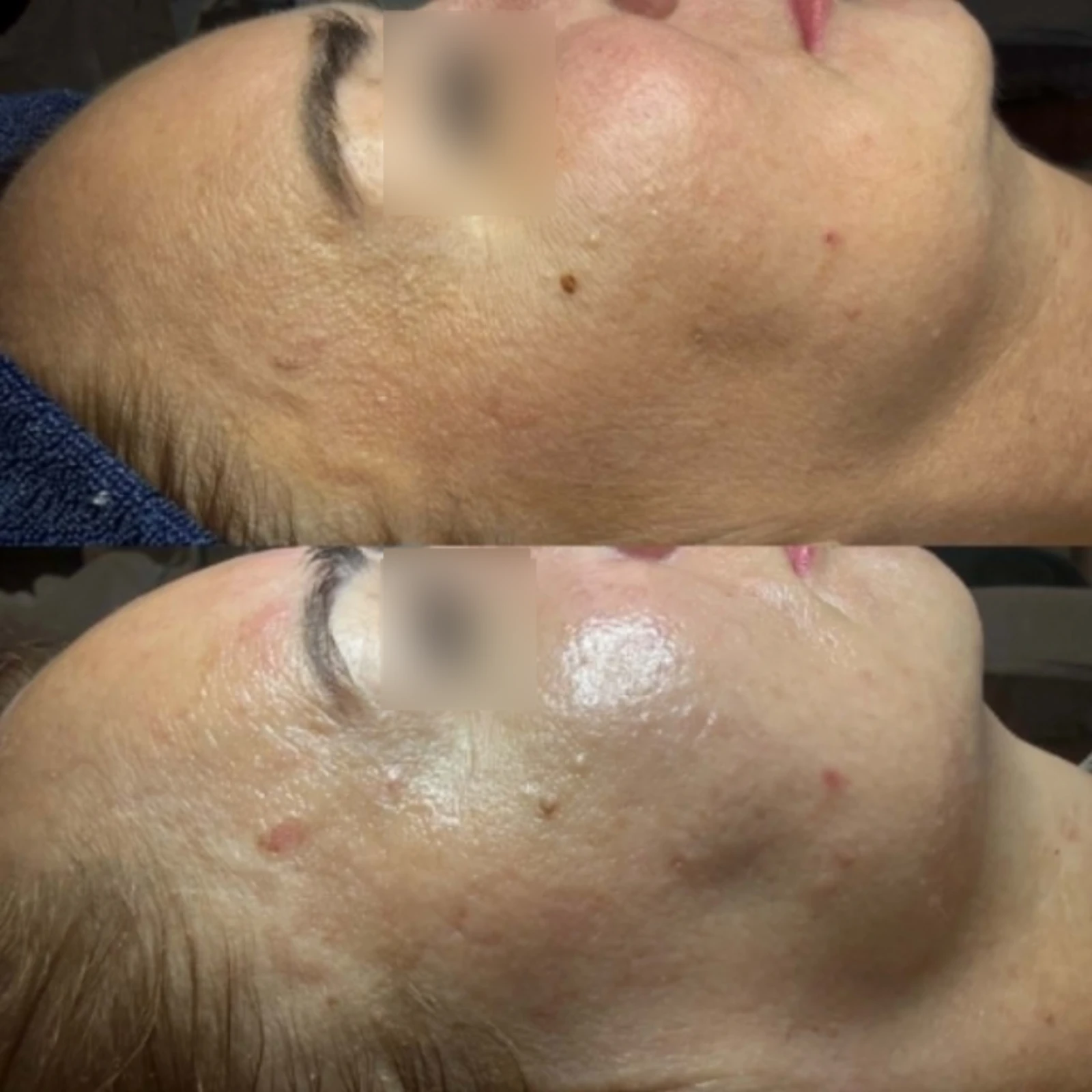 Dermaplaning