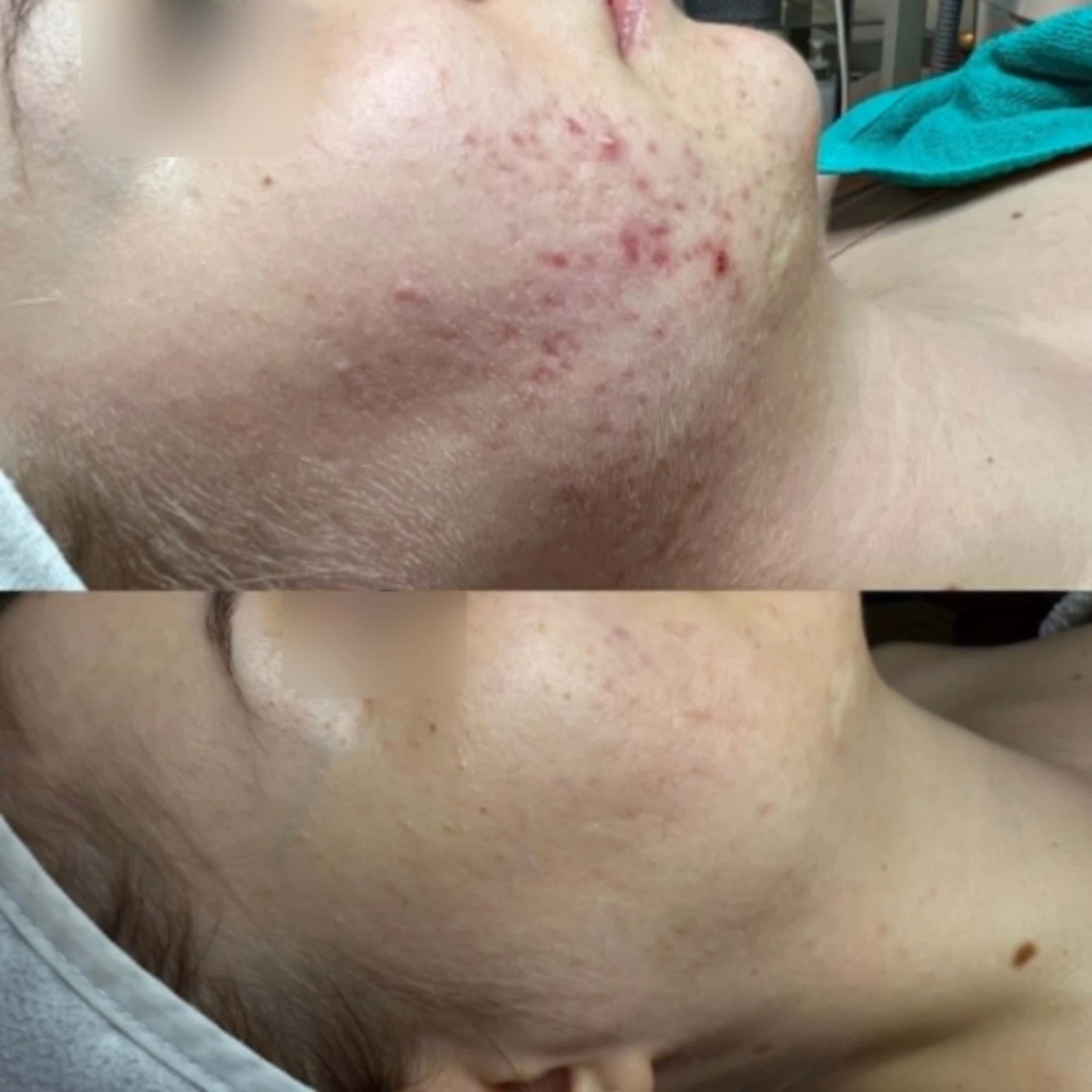 Hollywood Carbon Peeling & Akne Program