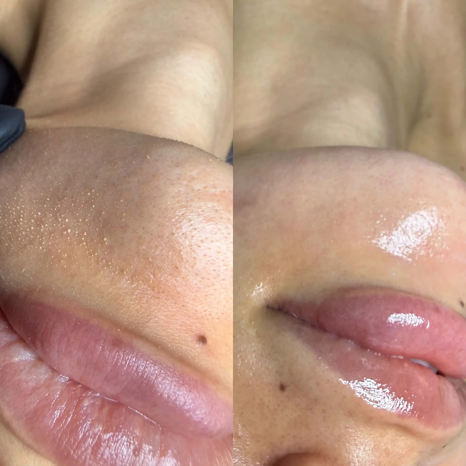 Dermaplaning